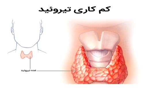 بی علامتی مشکل تیروئید در نوزادان و ضرورت غربالگری