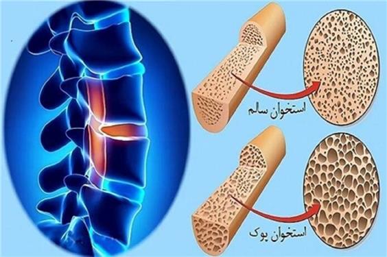 پوکی استخوان از دهه چهارم زندگی شروع می‌شود
