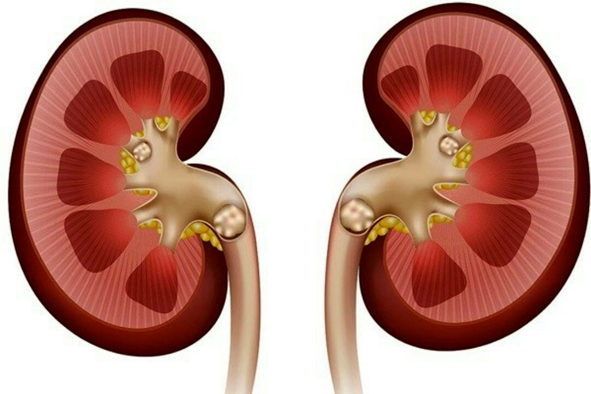دلیل تشکیل سنگ کلیه و معرفی انواع آن