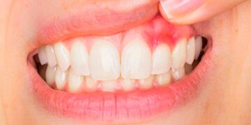 چه زمانی التهاب‌های دهان و دندان ناشی از بیماری‌های جدی مانند سرطان است؟