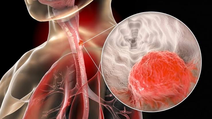 آیا ژنتیک نقشی در سرطان مری دارد؟