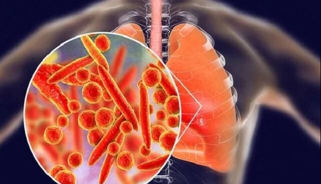 پنومونی؛ همچنان بزرگ‌ترین قاتل عفونی جهان
