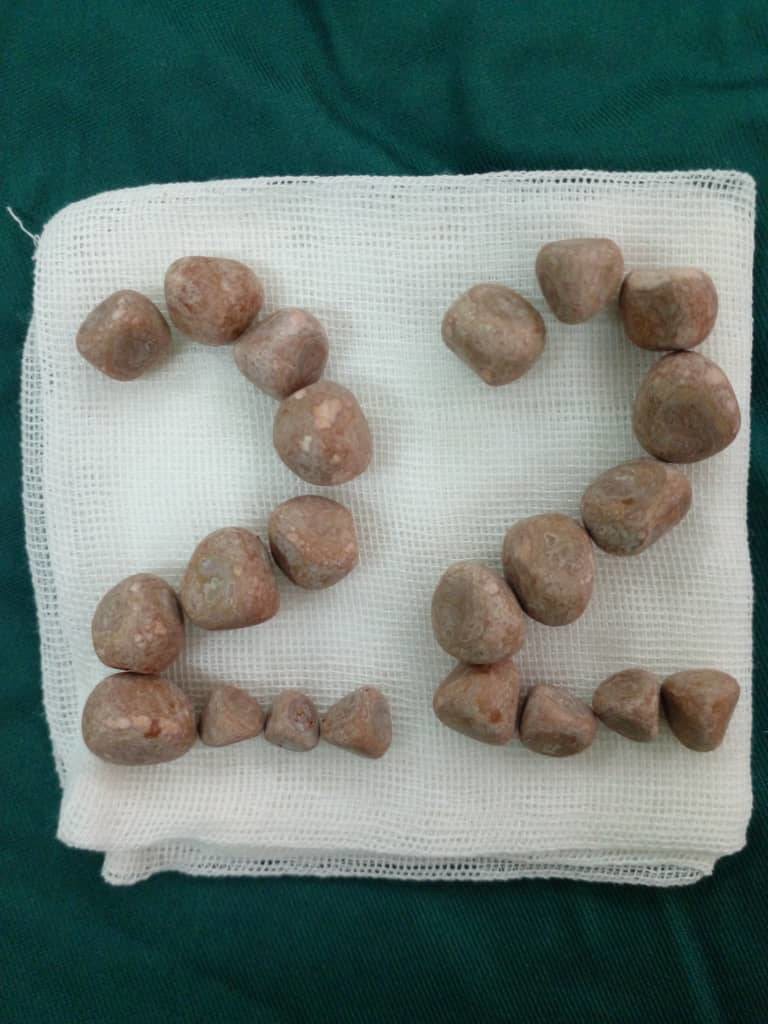 خارج‌ کردن ۲۲ سنگ از مثانه بیمار ۹۰ ساله در آباده