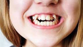 دلایل مهم دندان‌های نامرتب