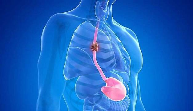 نکاتی درباره سرطان مری