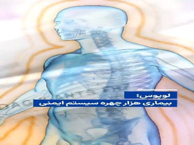 لوپوس؛ بیماری هزار چهره سیستم ایمنی