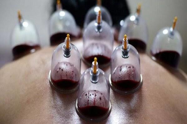 حجامت با بدن انسان چه می‌کند؟
